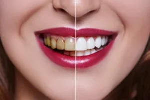 hollywood smile price in turkey